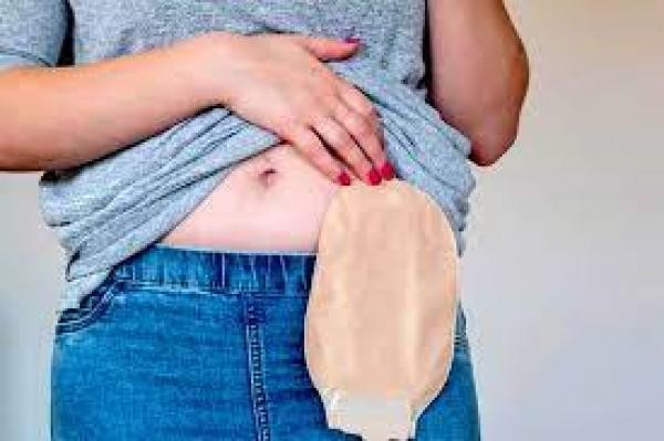 Sorriso: Bolsas de colostomia são entregues em casa para facilitar a vida do paciente